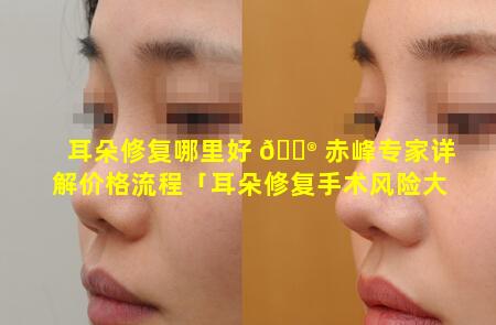 耳朵修复哪里好 💮 赤峰专家详解价格流程「耳朵修复手术风险大吗」